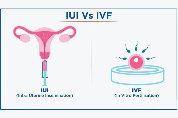 تفاوت IVF , IUI برای تعیین جنسیت جنین