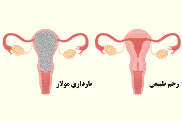 بارداری مولار از مشکلات کروموزمی